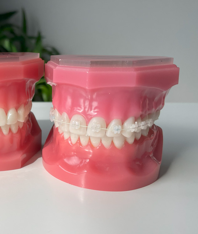 Ceramic braces