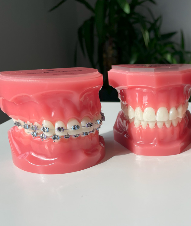 Traditional metal braces