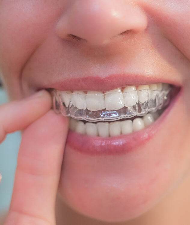 Clear aligners