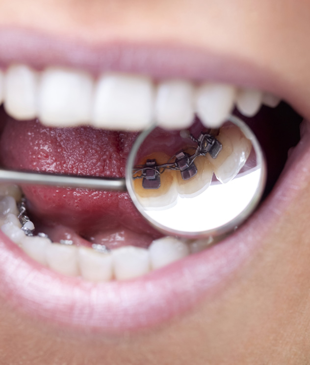 Lingual braces Lingual braces